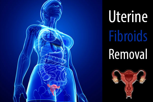 Uterine Fibroids Surgery Side Effects Uterine Fibroids Surgery Cancer 4335